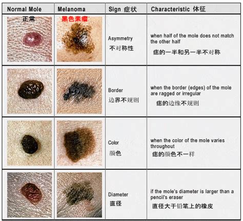 身体痣|身上的痣突然变化，要当心！25 条医生想告诉你的健。